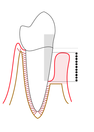 <span class="mw-page-title-main">Periodontal probe</span>