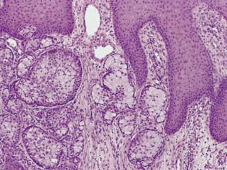 <span class="mw-page-title-main">Eccrine carcinoma</span> Medical condition