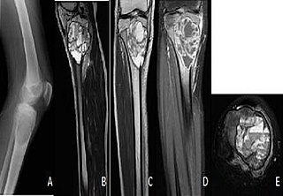 <span class="mw-page-title-main">Aneurysmal bone cyst</span> Medical condition