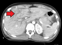 Grade 4 liver laceration Grade4LiverLacMark.png