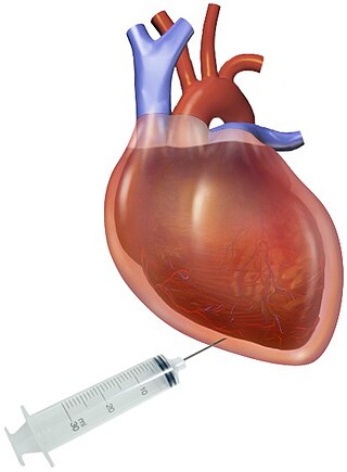 <span class="mw-page-title-main">Pericardiocentesis</span> Procedure where fluid is aspirated from the pericardium