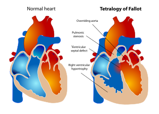 <span class="mw-page-title-main">Tetralogy of Fallot</span> Type of congenital heart defect