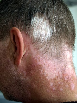 <span class="mw-page-title-main">Poliosis</span> Medical condition