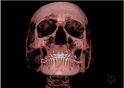 ConeBeam computerized tomography image of a post-operative orthognathic surgery Computer tomography Skull.jpg