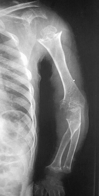 <span class="mw-page-title-main">Pseudoachondroplasia</span> Inherited disorder of bone growth