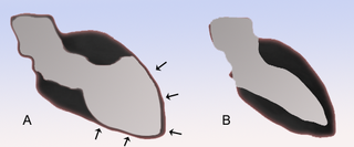 <span class="mw-page-title-main">Takotsubo cardiomyopathy</span> Sudden temporary weakening of the heart muscle