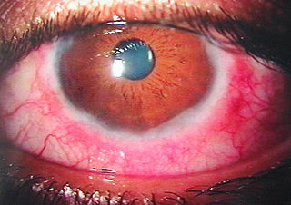 <span class="mw-page-title-main">Vernal keratoconjunctivitis</span> Medical condition