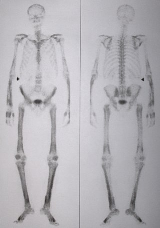 <span class="mw-page-title-main">Hypertrophic osteoarthropathy</span> Bone and joint disorder