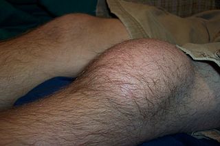 Prepatellar bursitis Inflammation of the prepatellar bursa at the front of the knee