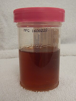 <span class="mw-page-title-main">Hematuria</span> Presence of blood in urine