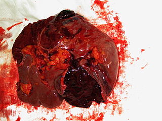 <span class="mw-page-title-main">Splenic injury</span> Injury to the spleen