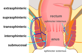 Anal fistula Disease of the anus