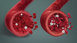 <span class="mw-page-title-main">Hypoglycemia</span> Health condition