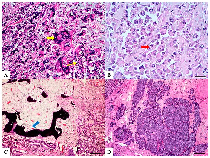 H&E stained sections (A) Colorectal choriocarcinoma: biphasic solid nests and trabeculae of mononucleated cells with clear cytoplasm (thin yellow arrow) and pleomorphic cells with abundant vacuolated or eosinophilic cytoplasm and single or multiple vescicular nuclei with conspicuous nucleoli (thick yellow arrow). (B) Rhabdoid colorectal carcinoma: rhabdoid cells characterized by a large, eccentrically located nuclei, prominent nucleoli (red arrow) and abundant eosinophilic cytoplasm. (C) Carcinoma with osseous metaplasia: osseous metaplasia (blue arrow) is recognized in conventional CRC as foci of bone formation in the stroma, with calcification, osteoid matrix, osteoclasts and osteoblasts. (D) Undifferentiated carcinoma: sheets of undifferentiated cells showing a variable grade of pleomorphism with no gland formation, mucin production or other line of differentiation.[9]