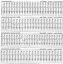 This Holter monitor strip of a 5-year-old showing atrial tachycardia. This person was eventually diagnosed with tachycardia-induced cardiomyopathy. ARYA-10-175f2.jpg