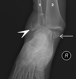 Ankle fracture Medical condition