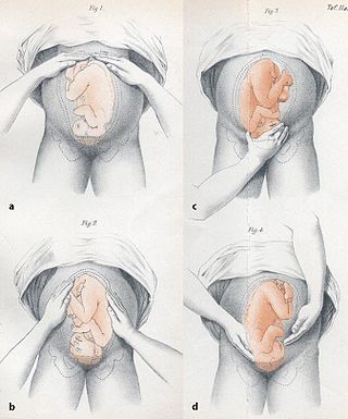 <span class="mw-page-title-main">Leopold's maneuvers</span> Way to determine the position of a fetus inside the womans uterus