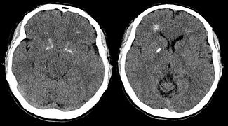 June 15: brain with DiGeorge syndrome