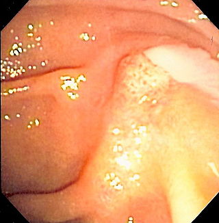 <span class="mw-page-title-main">Ascending cholangitis</span> Medical condition