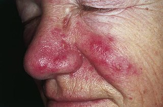 <span class="mw-page-title-main">Rosacea</span> Skin condition resulting in redness, pimples and swelling, usually on the face