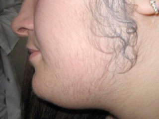 <span class="mw-page-title-main">Hirsutism</span> Excessive hair growth on parts of the body where hair is usually minimal