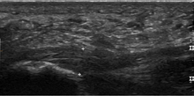 Thickened plantar fascia in ultrasound Plantarfascia.png