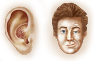 <span class="mw-page-title-main">Ramsay Hunt syndrome type 2</span> Presentation of shingles in the geniculate ganglion