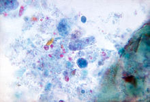 Dientamoeba fragilis (3027773918).jpg