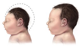 <span class="mw-page-title-main">Microcephaly</span> Condition in which the head is small due to an underdeveloped brain