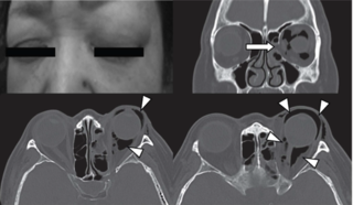 Orbital emphysema Medical condition