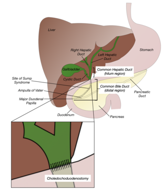 <span class="mw-page-title-main">Choledochoduodenostomy</span>