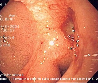 <span class="mw-page-title-main">Upper gastrointestinal bleeding</span> Medical condition