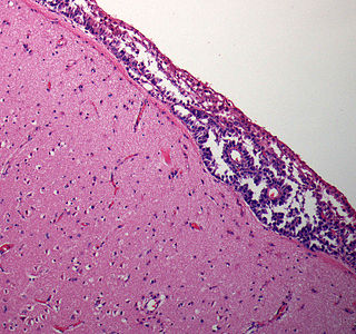 <span class="mw-page-title-main">Leptomeningeal cancer</span> Medical condition