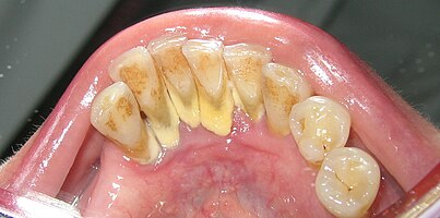 Photographic representation of calculus on the lingual of the mandibular anterior teeth. MandibularAnteriorCalculus.JPG