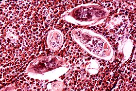 Schistosomiasis haematobia