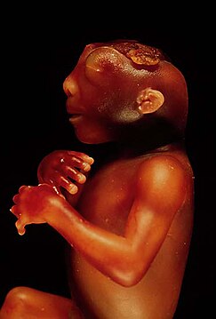 Anencephaly side.jpg