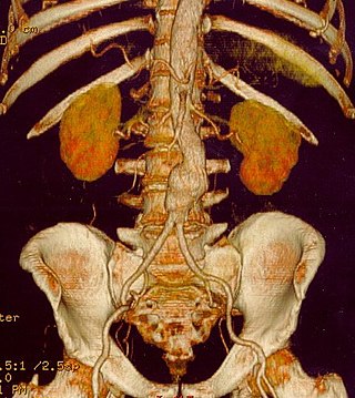 <span class="mw-page-title-main">Inflammatory aortic aneurysm</span> Medical condition