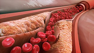 <span class="mw-page-title-main">Low-density lipoprotein</span> One of the five major groups of lipoprotein