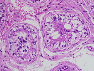 <span class="mw-page-title-main">Sertoli cell-only syndrome</span> Medical condition