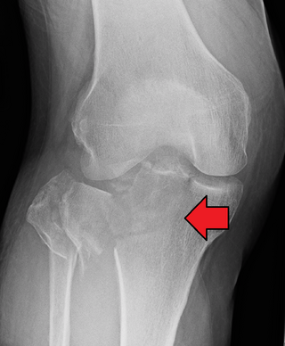 <span class="mw-page-title-main">Tibial plateau fracture</span> Medical condition