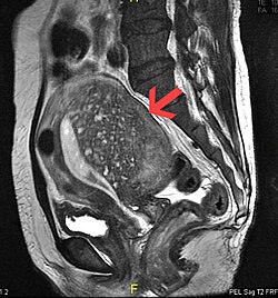 Adenomyosis MRI.jpg