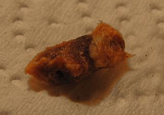 <span class="mw-page-title-main">Earwax</span> Waxy substance secreted by the ear