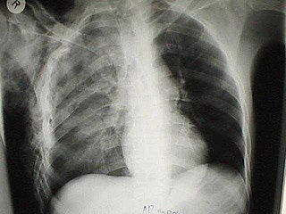 <span class="mw-page-title-main">Chest injury</span> Medical condition