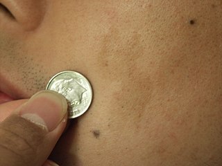 <span class="mw-page-title-main">Café au lait spot</span> Type of birthmark caused by a collection of melanocytes