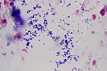 Gram-positive stain, possibly showing staphylococcus aureus, which is one of the primary causes of orbital cellulitis. Gram-positive stain.jpg