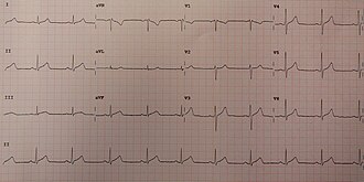 ECG showing slight ST elevation in many leads congruent with pericarditis Acute pericarditis.jpg