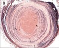 Thrombus showing circumferential lines of Zahn.