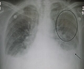 <span class="mw-page-title-main">Acute decompensated heart failure</span> Medical condition