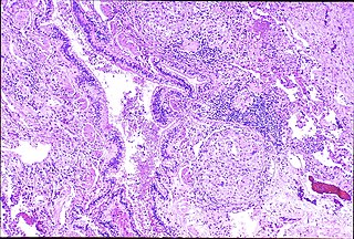 <span class="mw-page-title-main">Berylliosis</span> Medical condition