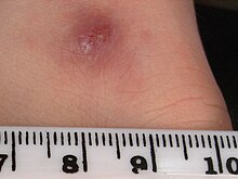 Cutaneous leishmaniasis Cutaneous leishmaniasis3.jpg